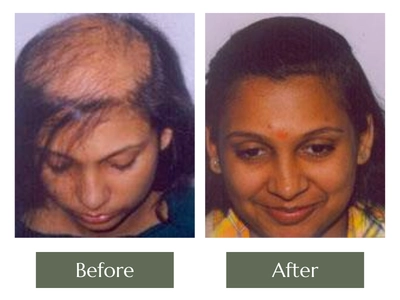 Before and After Hairline Reconstruction