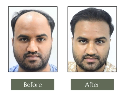 Before and After Full Beard Restoration