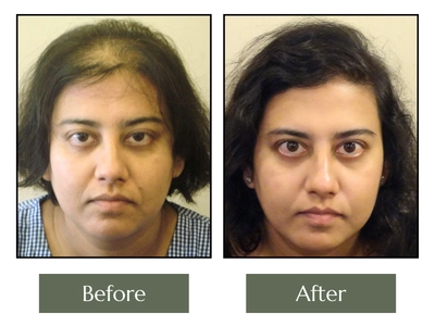 Before and After Vertex Coverage