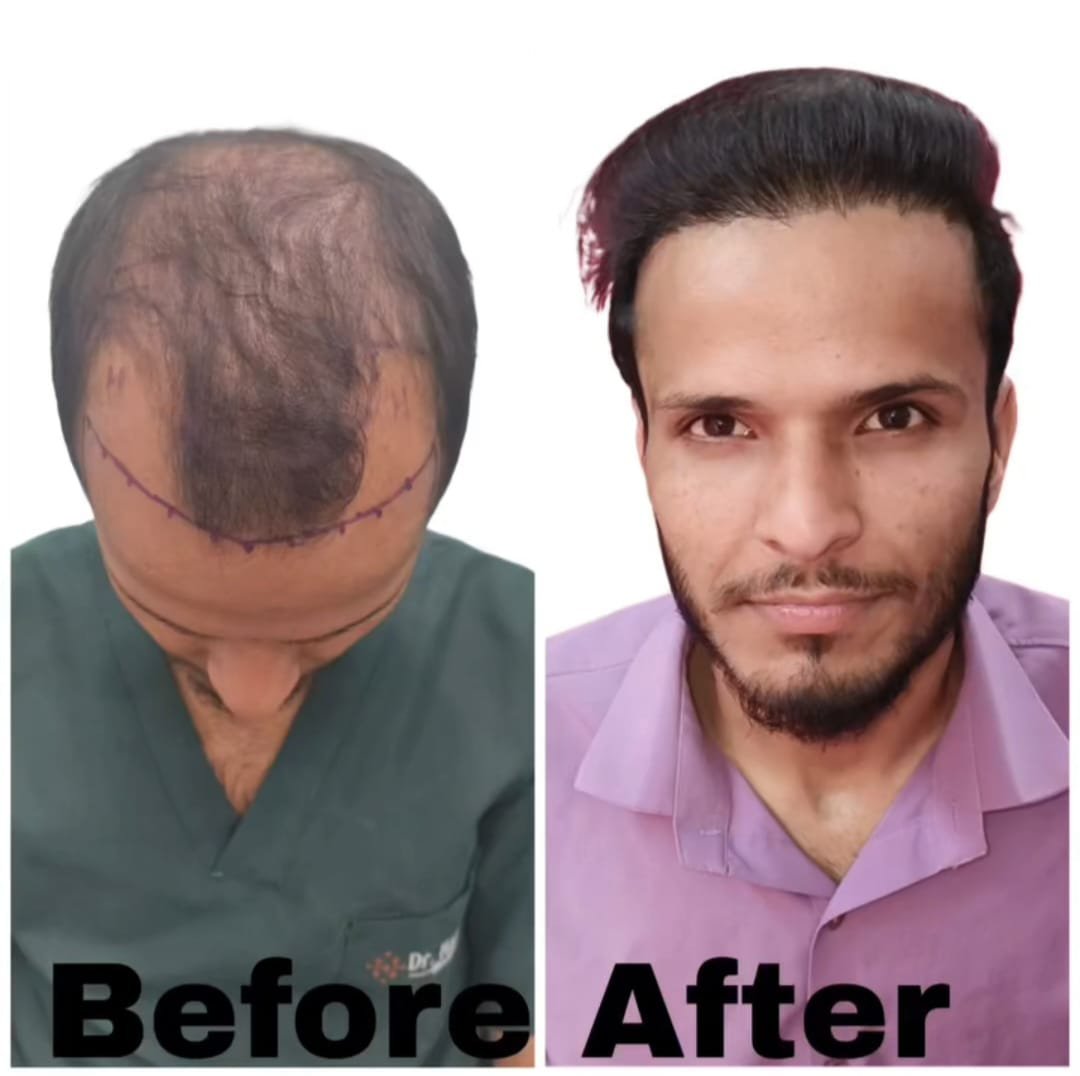 Before and After Vertex Coverage