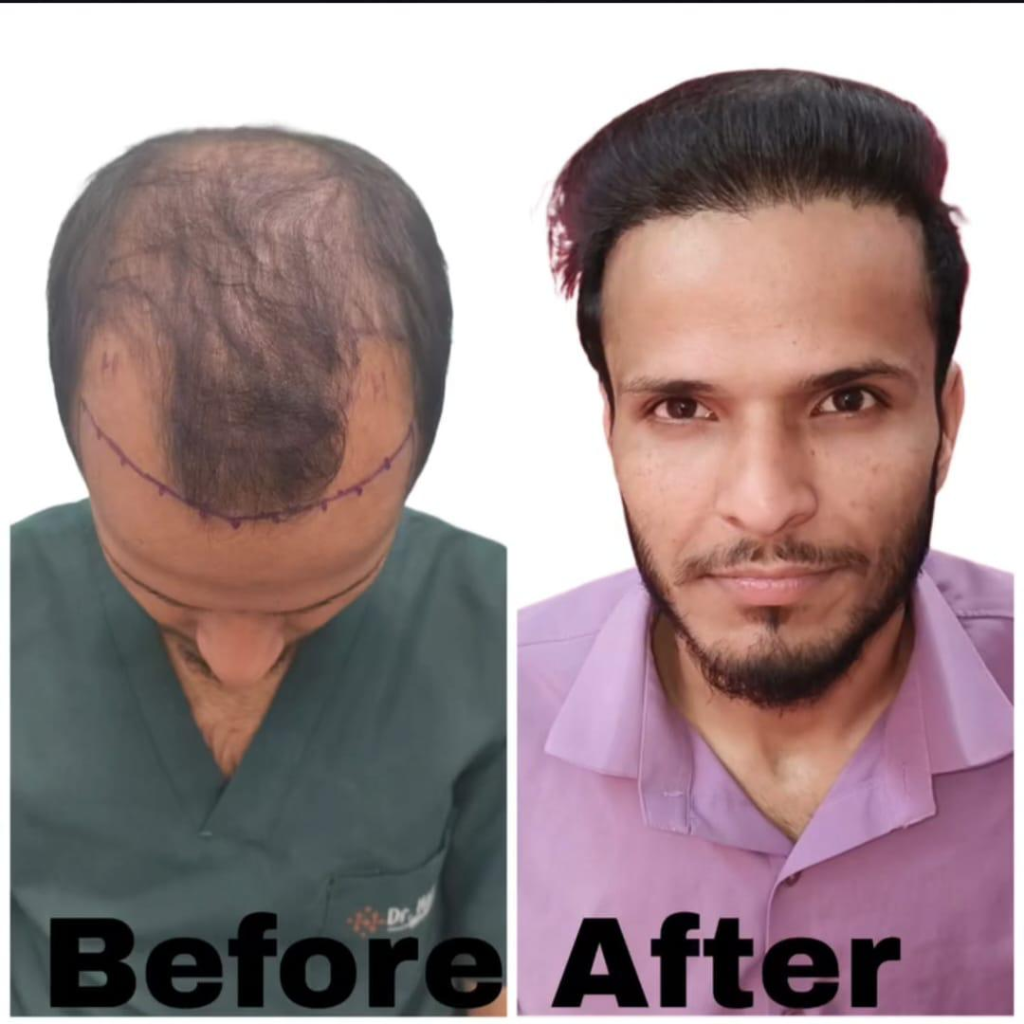 Hair Transplant Before After Result - Crown & Frontal Restoration