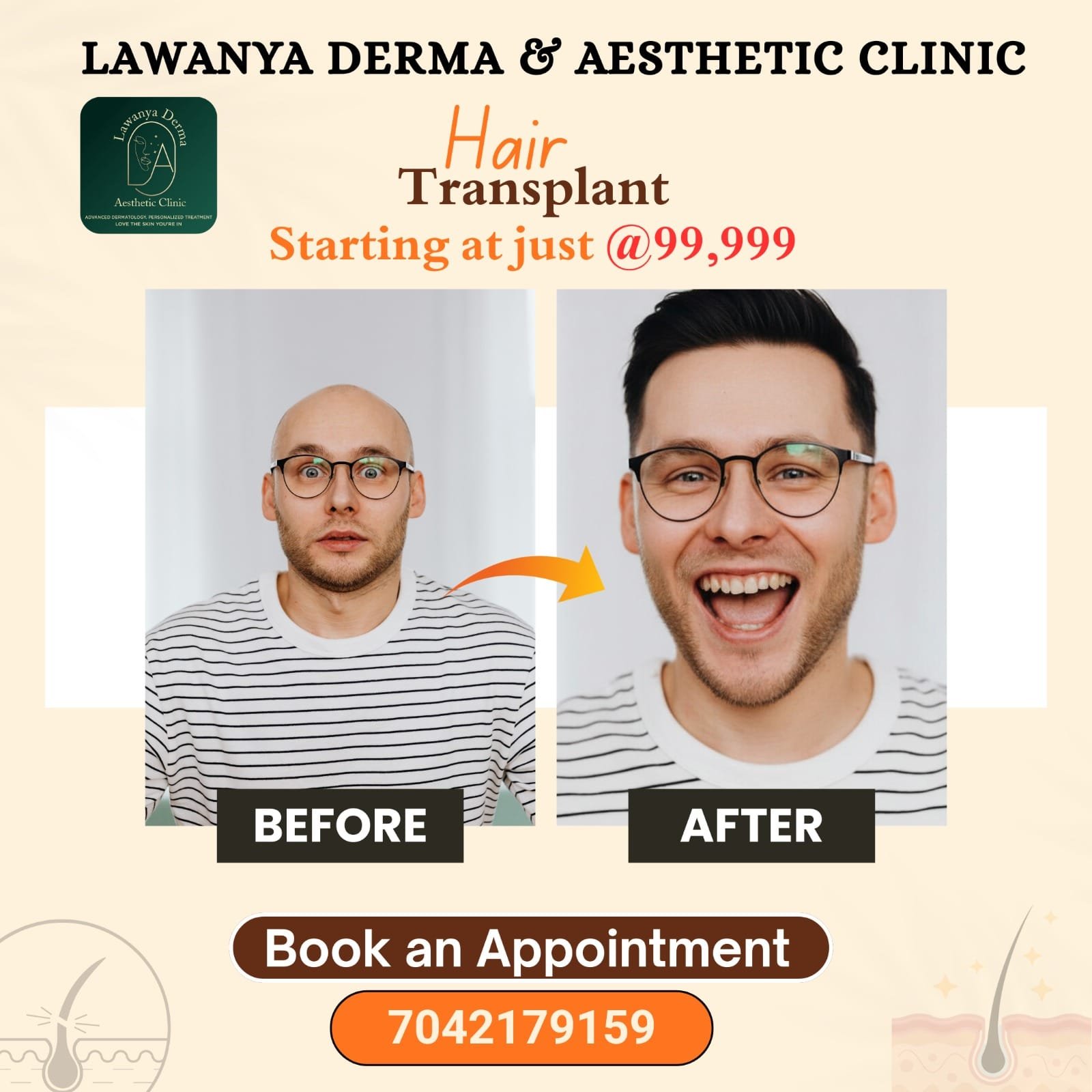 Hair Transplant Before After Result - Crown Area Restoration