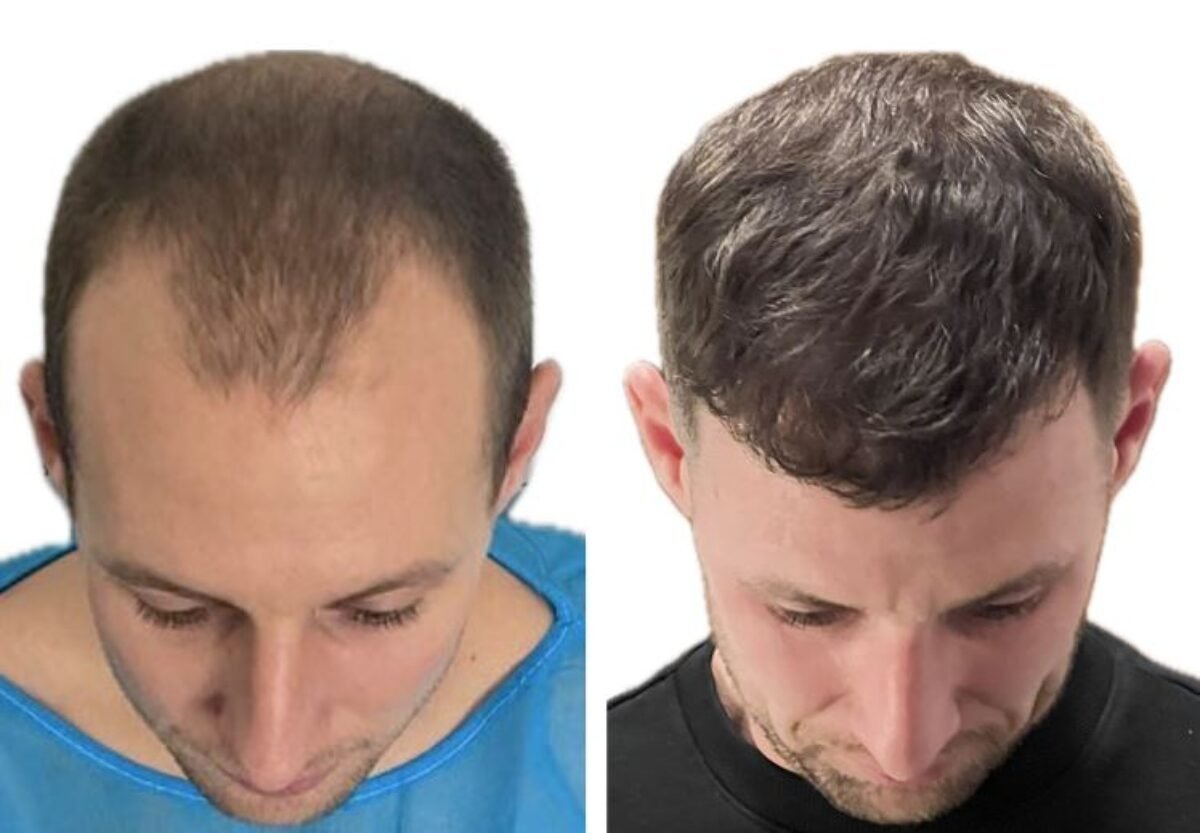 FUT Hair Transplant