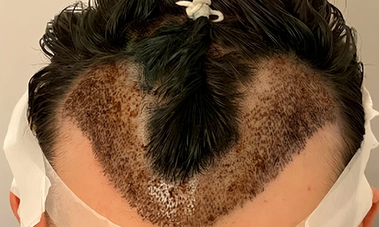 No-Shave / Partial-Shave FUE