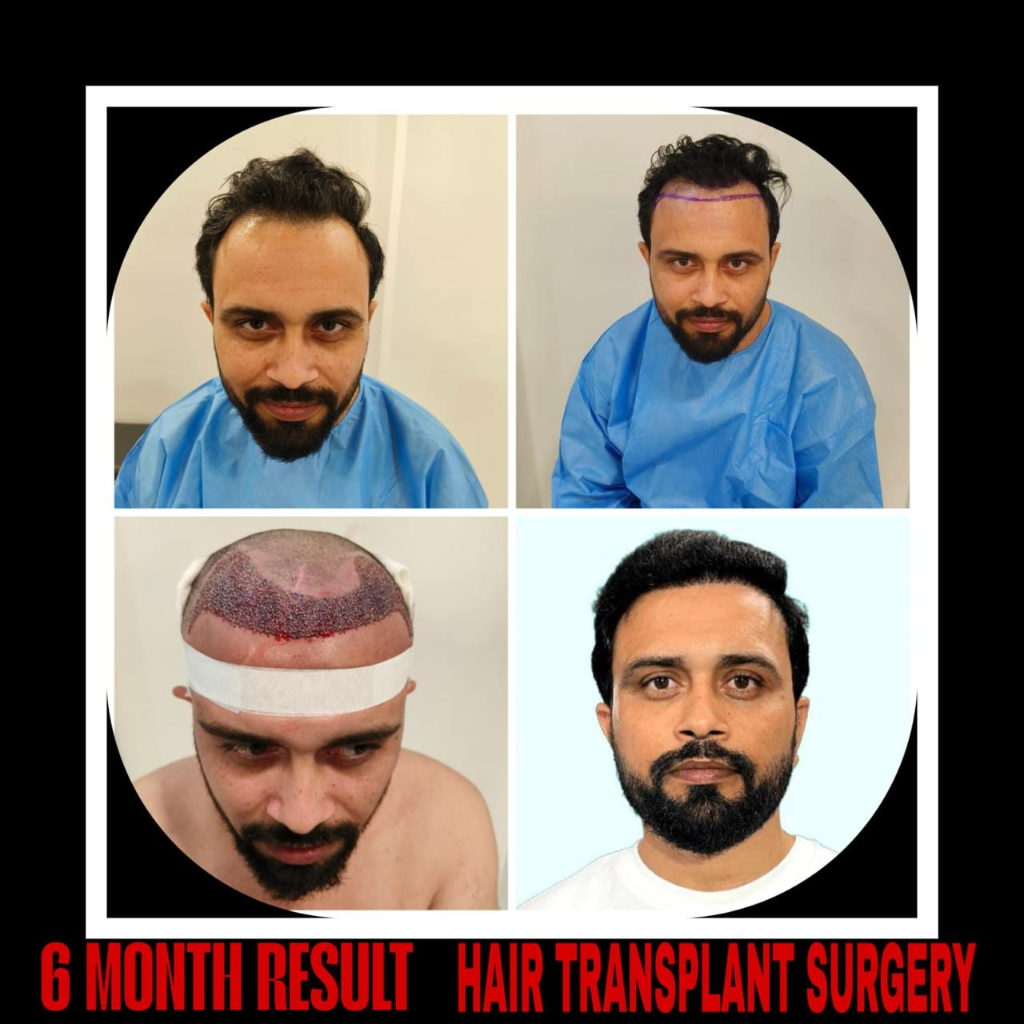 Best Hair Transplant Surgery Result in Delhi - Lawanya Derma
